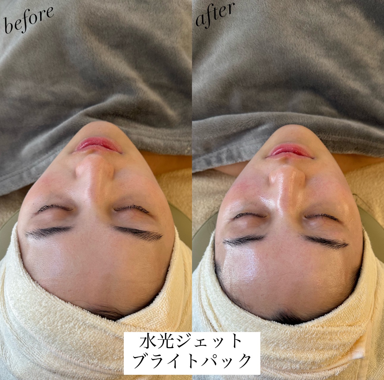 【2024】お歳暮・冬ギフト リフトアップ導入美容機器⭐︎水光ジェット・ 美容エア鍼・針の ボディ・フェイスケア